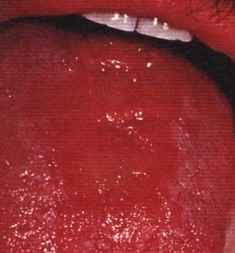 La candidiasis bucal (Candida albicans)