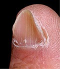 Coiloniquia: uñas cóncavas o en forma de cuchara