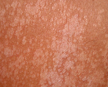 Más datos de interés popular sobre las infecciones por hongos en la piel