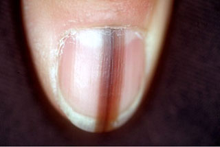 Líneas negras en las uñas (melanoniquia lineal )